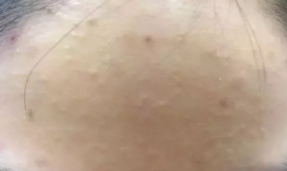 去除粉刺的注意事项有哪些？