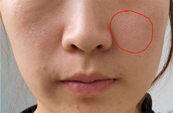 毛孔粗大 毛孔粗大如何预防?毛孔粗大预防措施